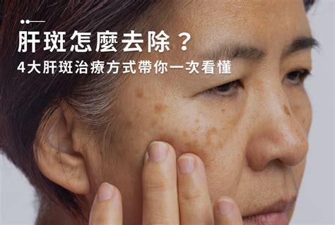 臉頰的斑|一次解析曬斑、肝斑、雀斑、顴骨母斑等皮膚黑斑原因…